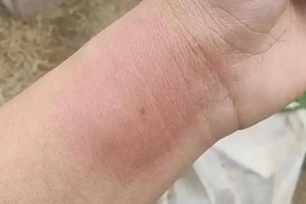 被虎头蜂蛰了如何处理，需及时清洗伤口