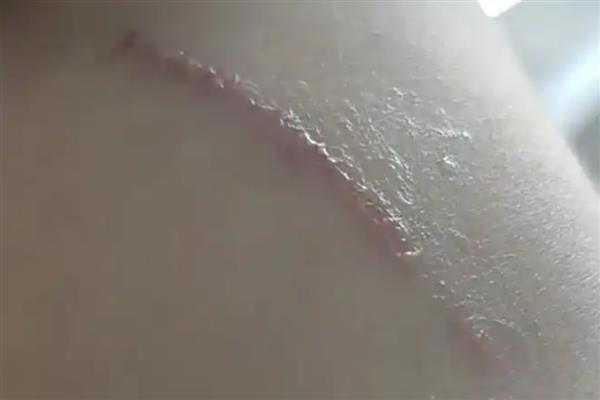 隐翅虫有没有毒，身体各段都含有毒素