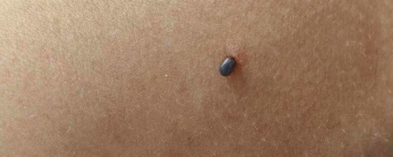 什么是蜱虫，是一种节肢动物寄生虫